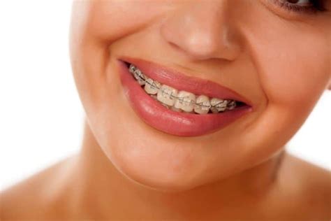 precio de los brackets en Mexico